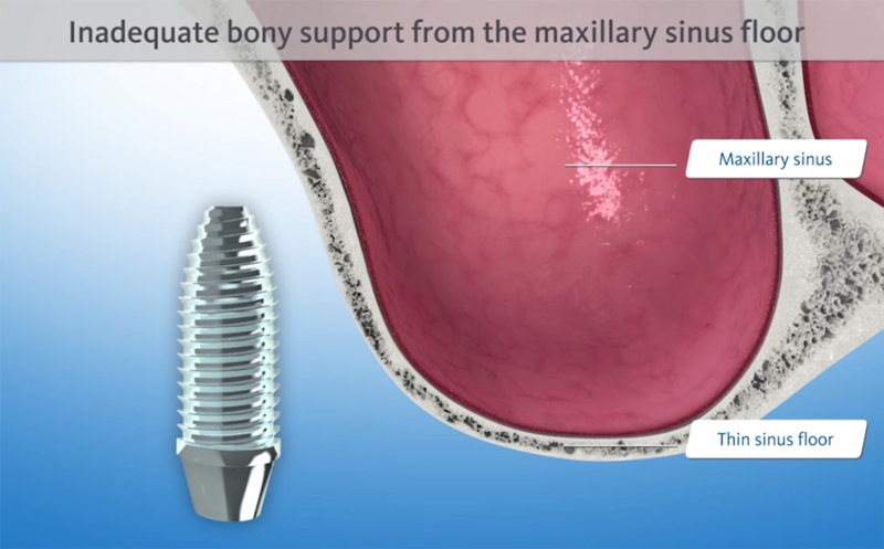 Digital illustration showing inadequate bony support for a dental implant from the maxillary sinus floor