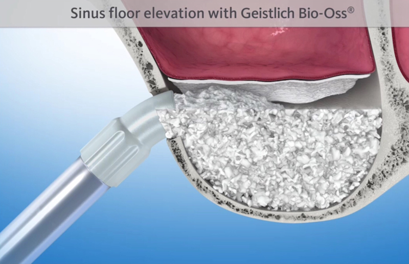 Digital illustration of a sinus floor elevation with Geistlich Bio-Oss.