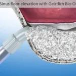 Digital illustration of a sinus floor elevation with Geistlich Bio-Oss.
