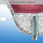 Digital illustration showing the insertion of a dental implant after the bone graft to provide adequate support to the implant