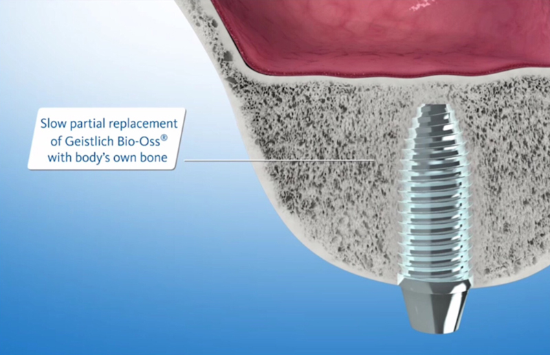 Digital illustration showing the bone graft after healing and the body replaces the Geistlich Bio-Oss with it's own bone