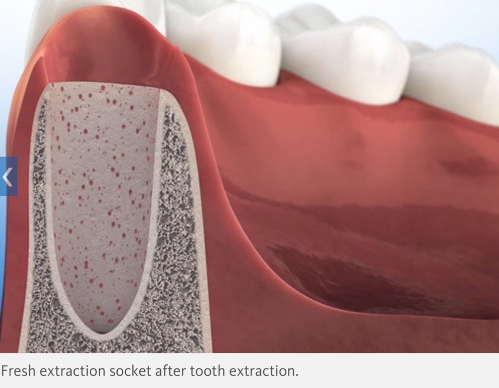 Digital illustration of a tooth socket after tooth extraction
