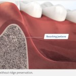 Digital illustration of bone loss after a tooth extraction without ridge preservation