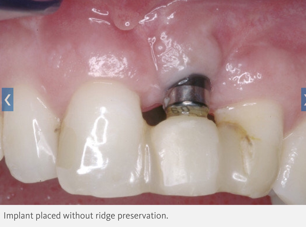 Case example of a dental implant after a tooth extraction without ridge preservation- the dental implant screw is visible above the gum line