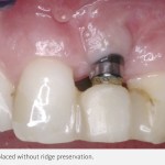 Case example of a dental implant after a tooth extraction without ridge preservation- the dental implant screw is visible above the gum line