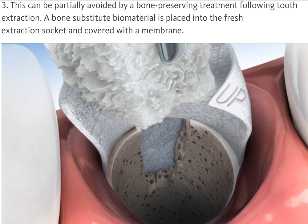 Digital illustration of bone substitute being placed in a tooth socket