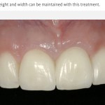 Case example of a successful dental implant with socket preservation